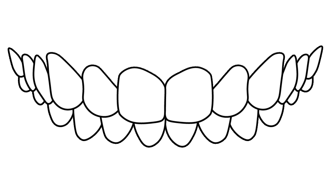Sobremordida