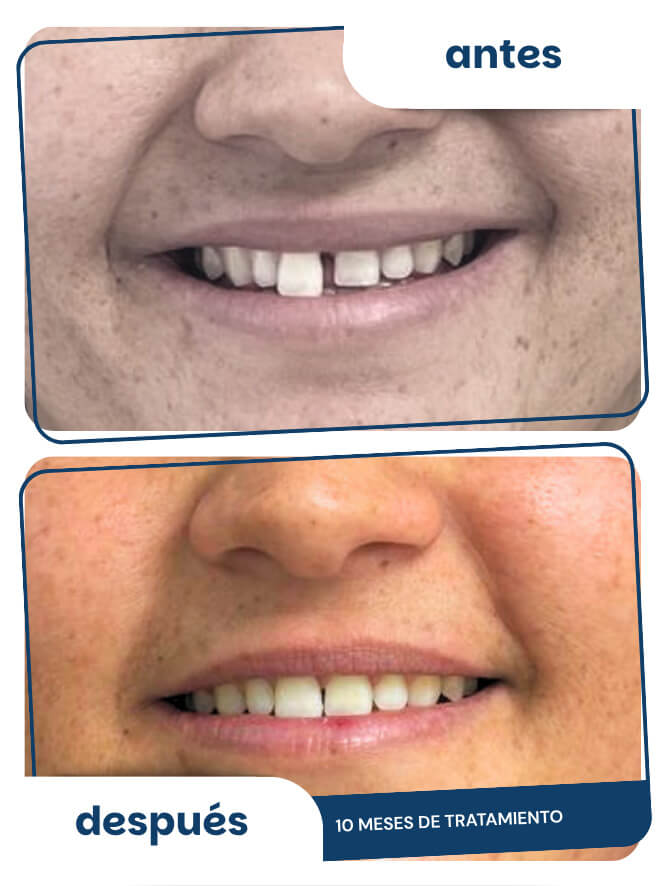 antes-despues-1