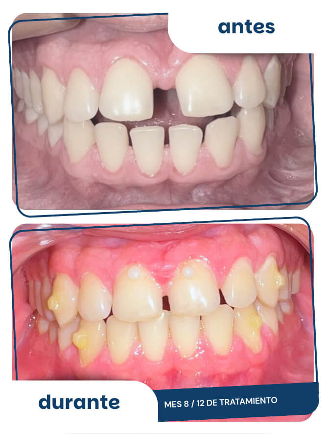 antes-despues-3