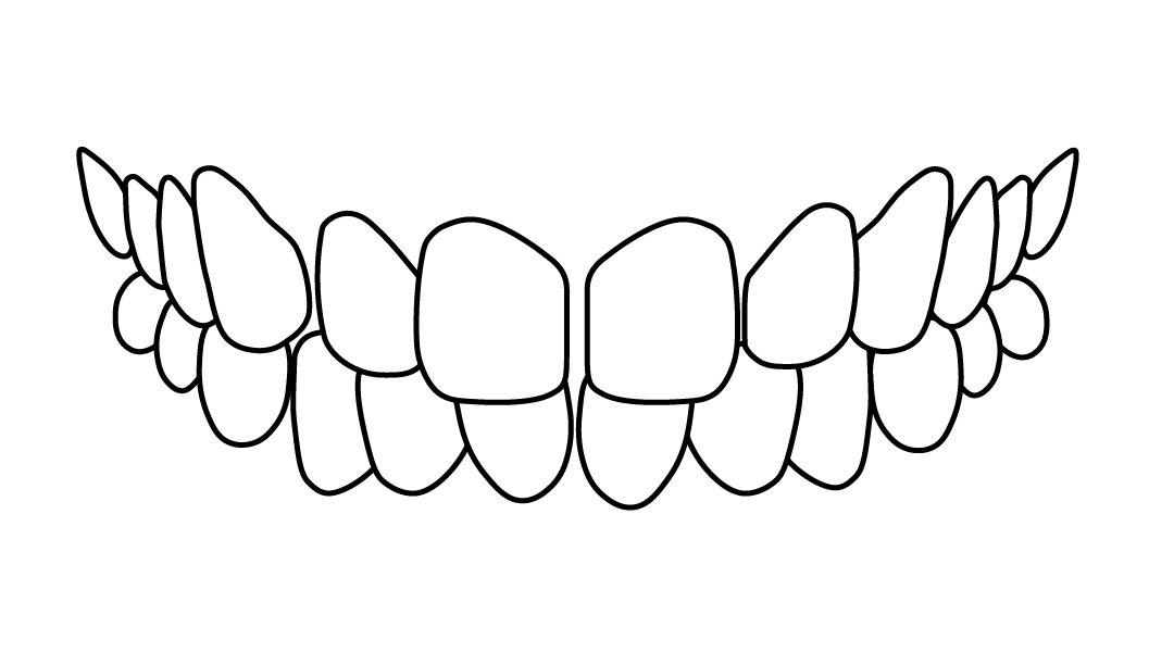 dientes-separados