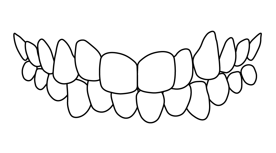 dientes torcidos