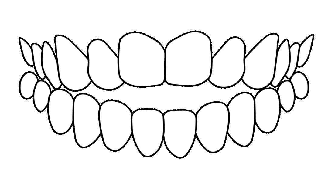 mordida-abierta