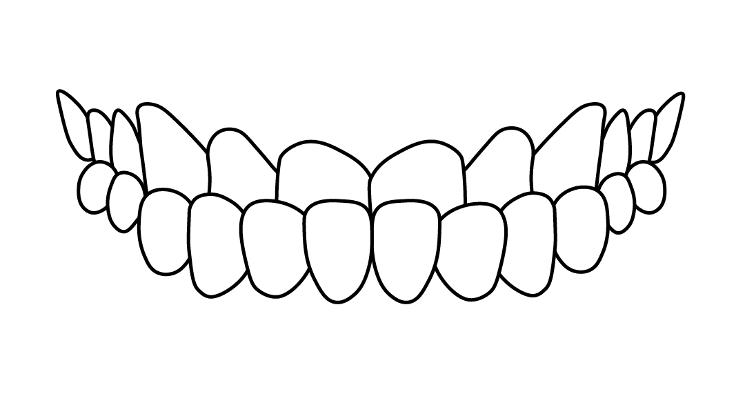 mordida-cruzada