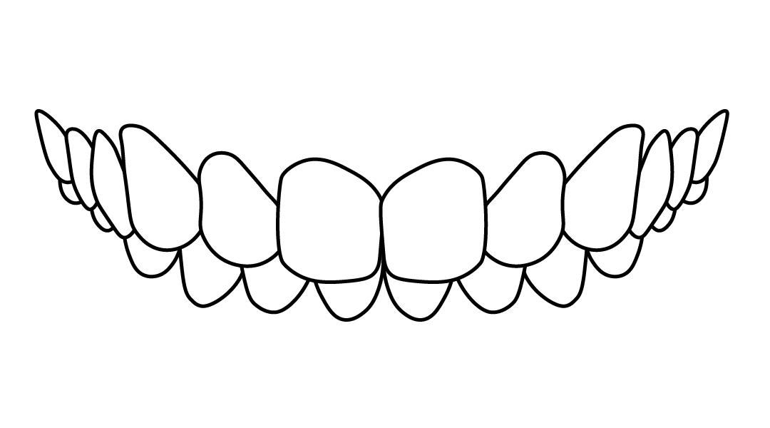 sobremordida